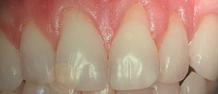 diş eti çekilmesi nedenleri belirtileri tedavisi